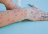 Ceará confirma primeiro caso de Mpox em 2026