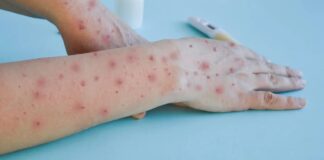 Ceará confirma primeiro caso de Mpox em 2026