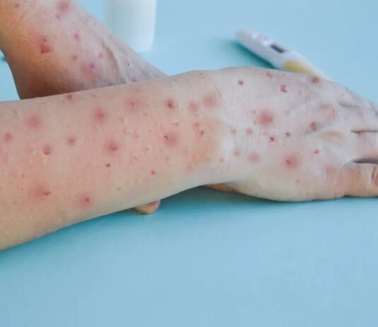 Ceará confirma primeiro caso de Mpox em 2026